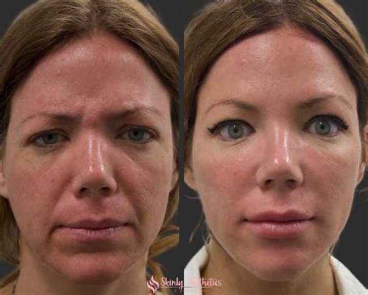 Before and after picture of model Bre Tiesi.