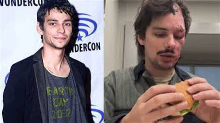 Devon Bostick Accident Update 2023: Where Is He Now? Devon Bostick Facial Injury