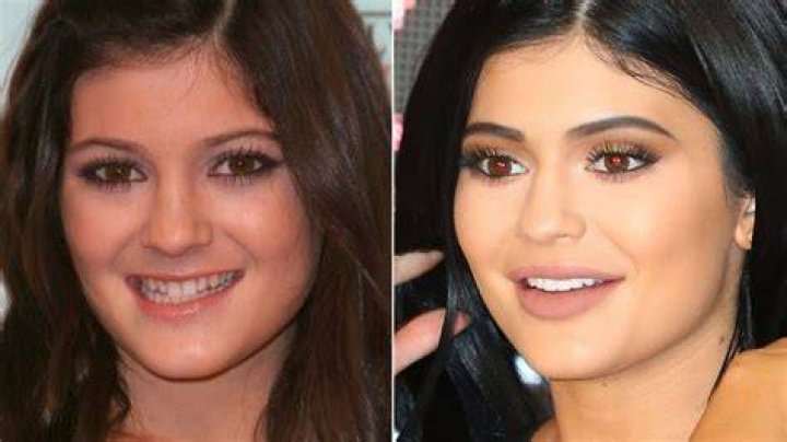 Does Kylie Jenner Look Better Before or After Getting Veneers?