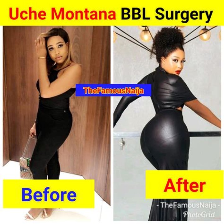 Himynamestee BBL Surgery | Before And After Photos