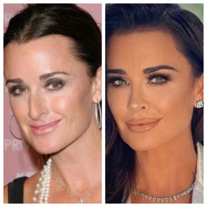 Kyle Richards before and after her teeth makeover.Â